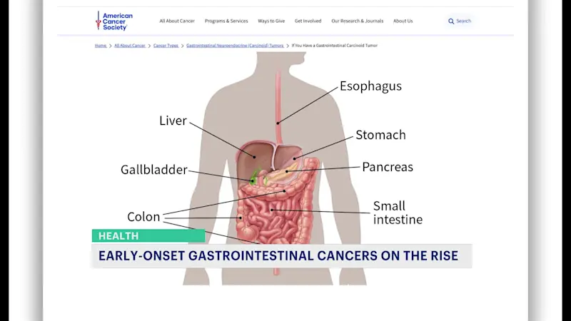 Story image: Report: More people under 50 are being diagnosed with gastrointestinal cancers