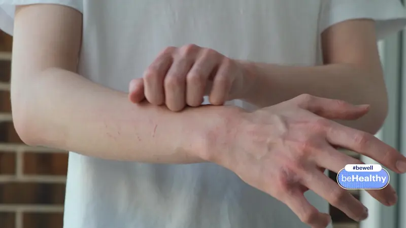 Story image: Helpful info for those suffering from chronic hand eczema & sleep disruption