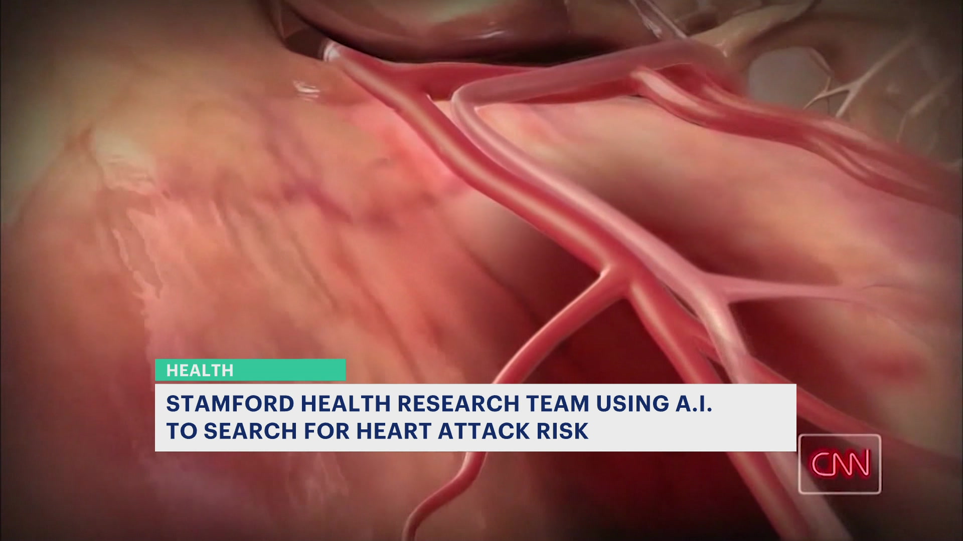 Stamford Health研究人员使用AI来确定一个人患心脏病的风险