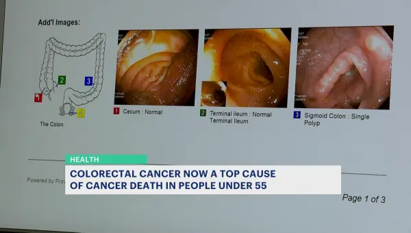  American Cancer Society: More people under 55 are dying from colorectal cancer