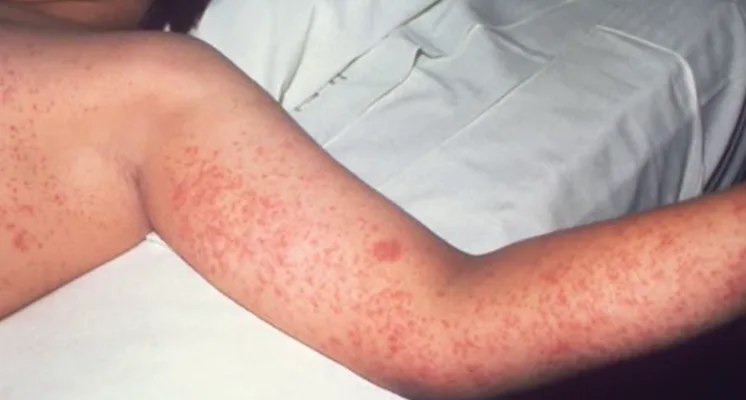 Measles