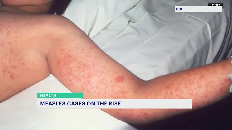 Story image: Health officials report uptick in measles cases across NJ, urge residents to get vaccine
