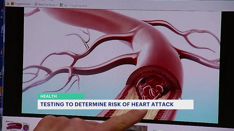 Story image:  Cardiologists: Screening tests can determine your risk of having a heart attack