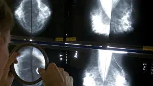 Westchester doctor says new breast cancer screening recommendation does not go far enough