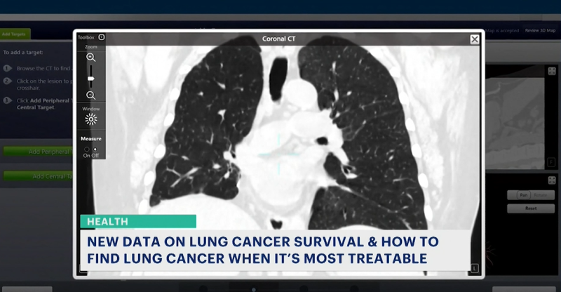 Story image:  Tech advancements, new treatments fuel spike in lung cancer survival rates