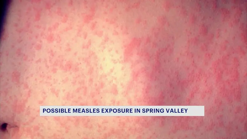 Story image: Rockland health officials warns of possible measles exposure in Spring Valley