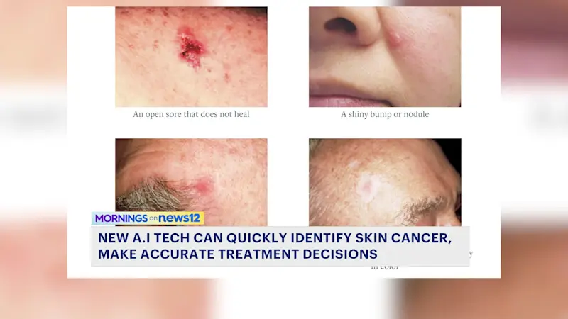 Story image: Yale study finds AI aiding in more accurate treatment for skin cancer