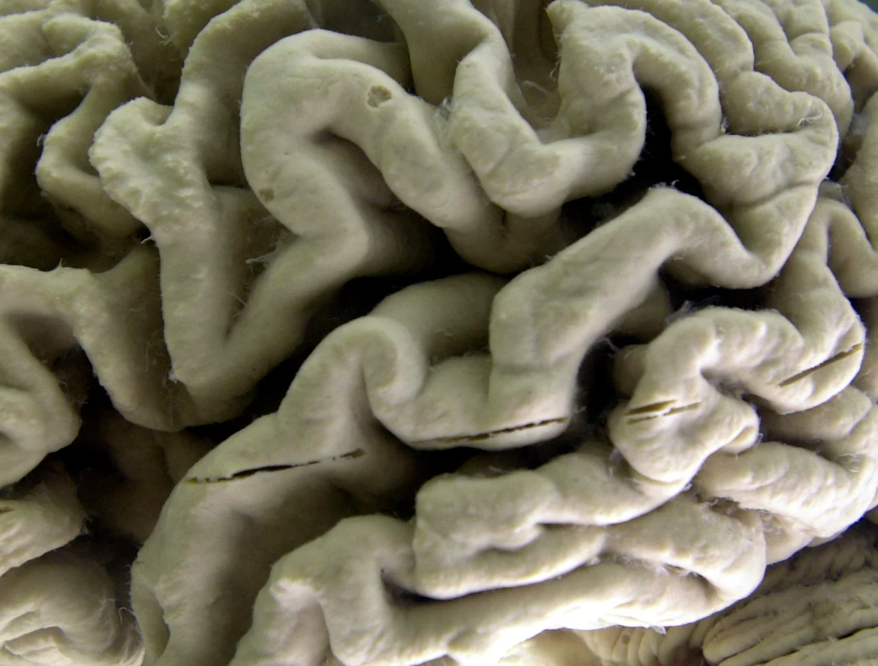 Alzheimer's