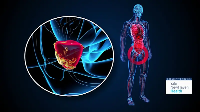 Story image: be Well: Procedure to treat enlarged prostate