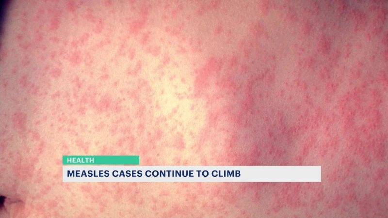 Story image: CDC: Measles could lose 'elimination status' amid uptick across the U.S.