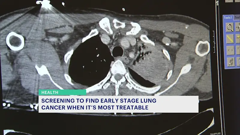 Story image:  Doctor: Most people eligible for lung cancer screenings do not make appointments