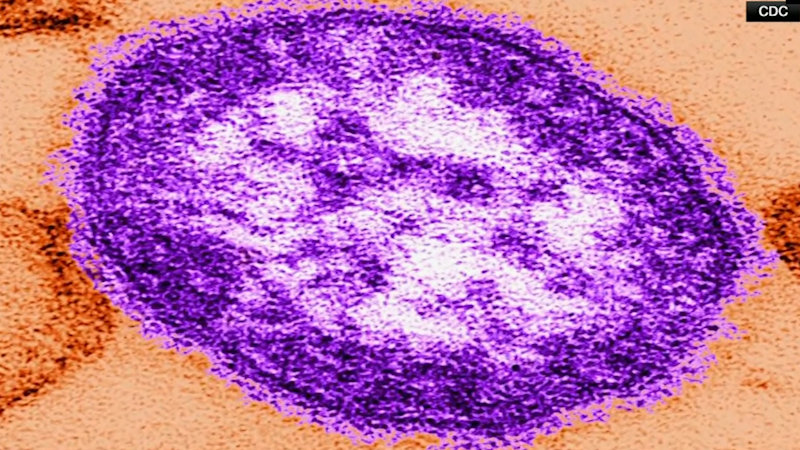 Story image: NYDOH: 3 measles cases identified in Orange County children