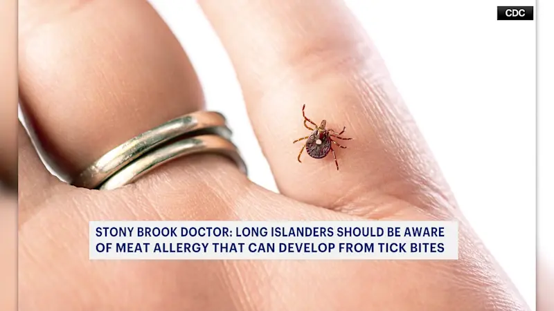 Story image: Long Island health official discusses warning signs after tick-related meat allergy death in New Jersey