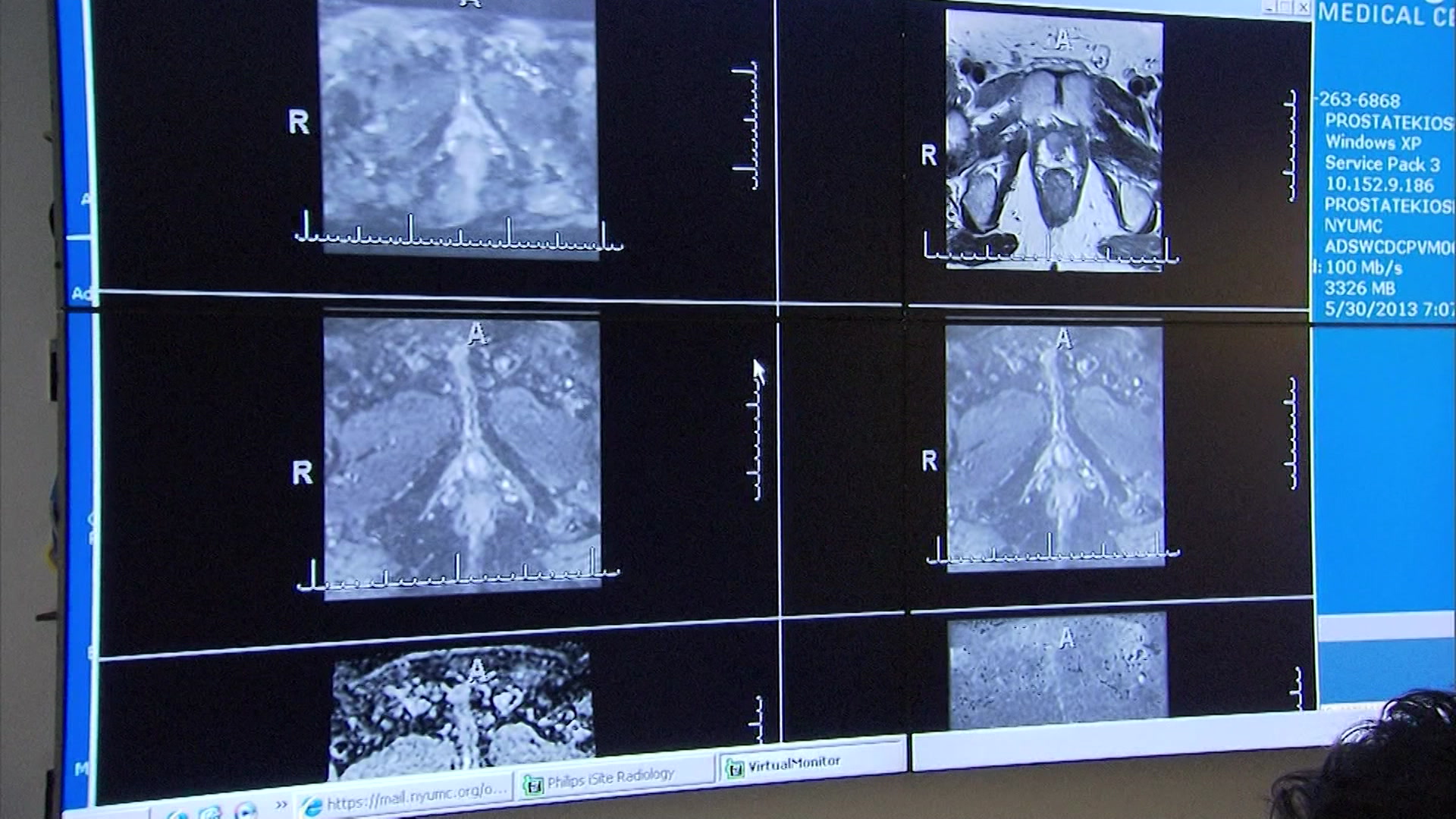 医師らは男性に前立腺がん啓発月間に検査を受けるよう促す