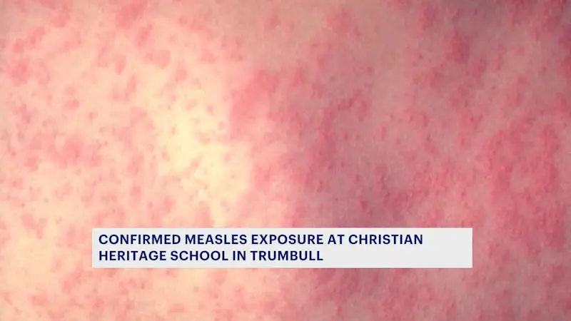 Story image: Connecticut reports 1st measles case since 2021