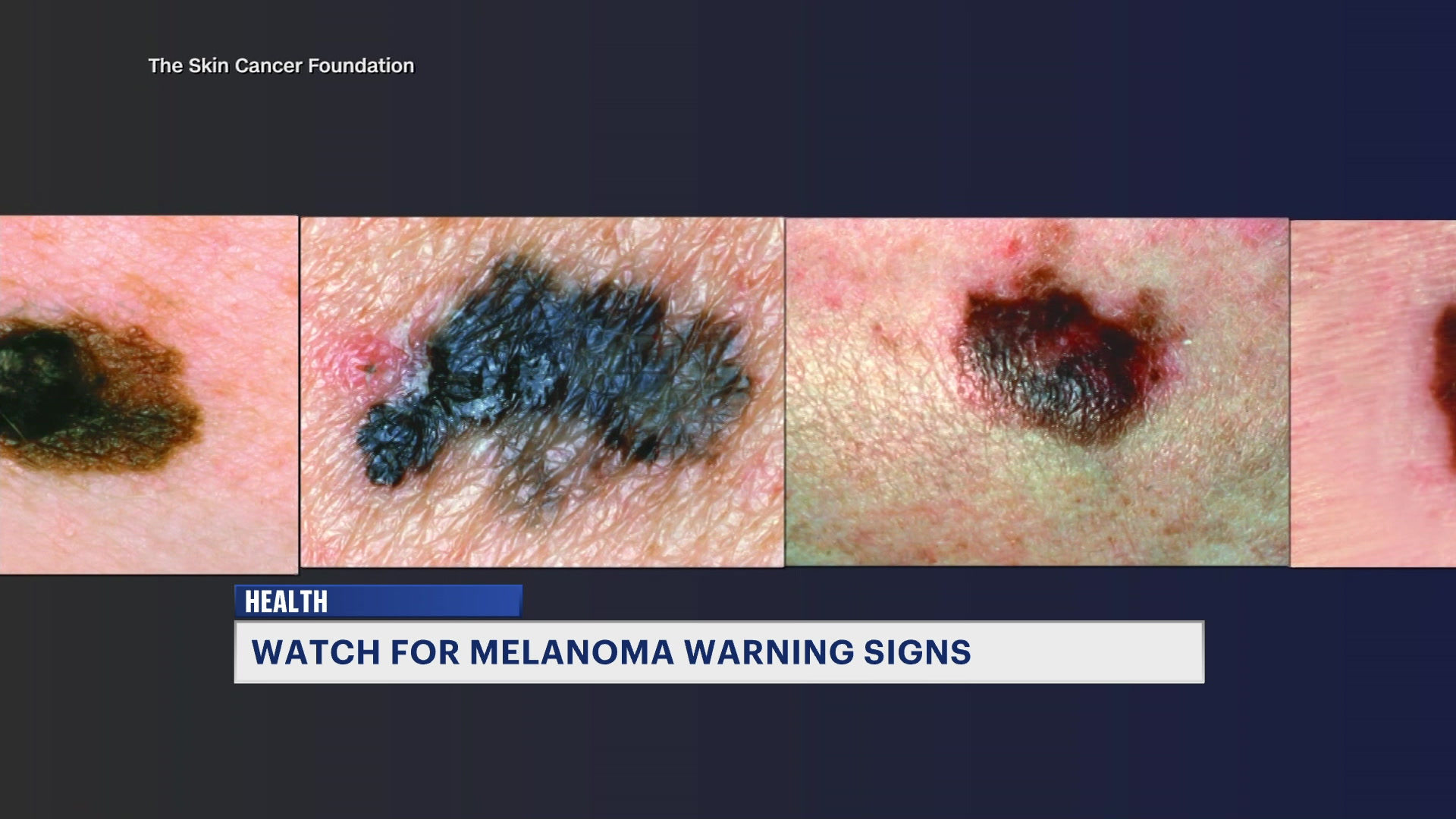 MTNJSkinCancer0505_2026-05-05-18-25-27