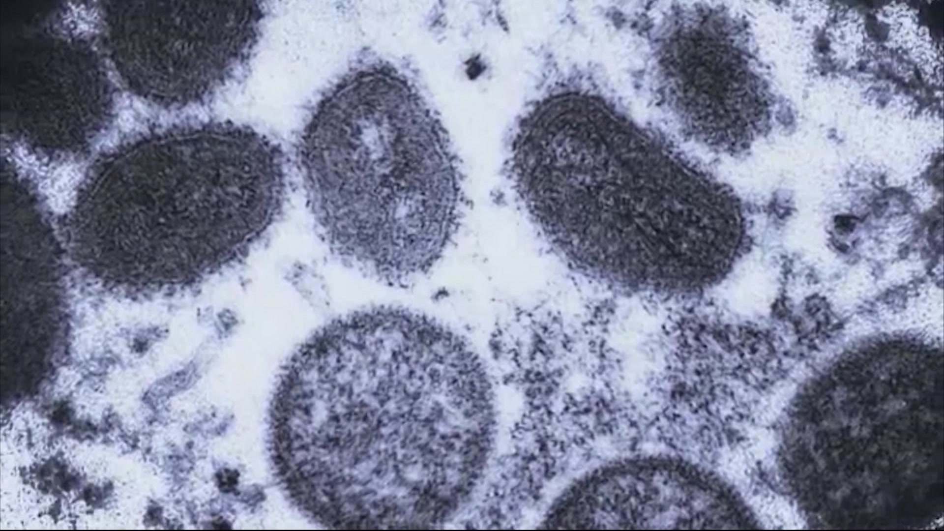 News 12 | The Bronx | New York City confirms first monkeypox case in child