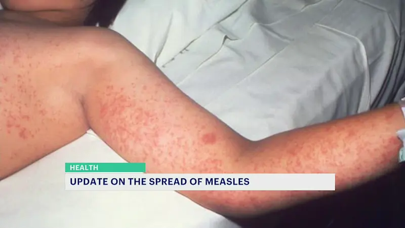 Story image: Measles death, outbreak in Texas puts health officials in tri-state on notice