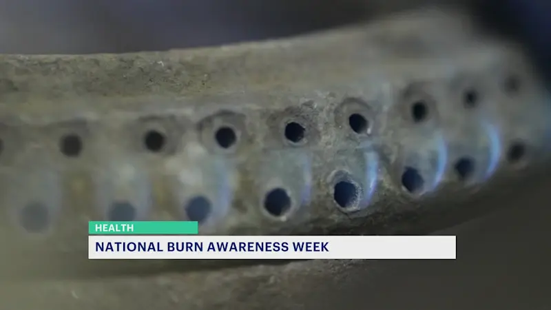 Story image:  'Prevention is best.' Health experts provide safety tips on burn awareness week