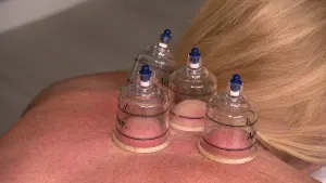 be Well: Cupping therapy