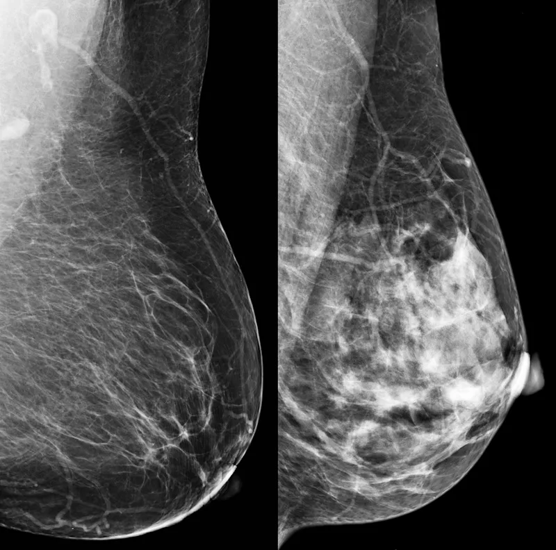 2mammograms.jpg